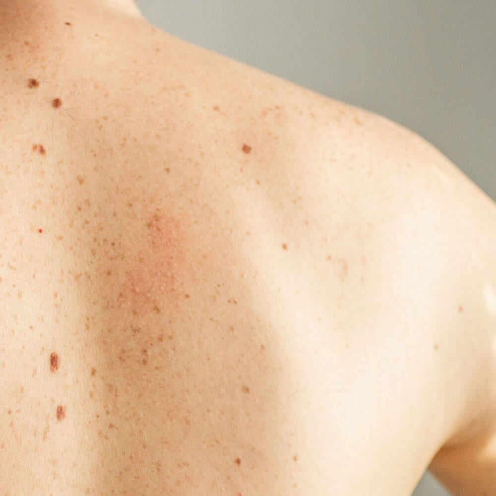 Moles and Skin Growths in West Palmdale, CA | Sandhu Dermatology