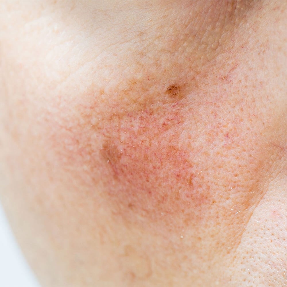 Rosacea in West Palmdale, CA | Sandhu Dermatology